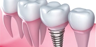 an image of healthy teeth with a dental implant in the jaw